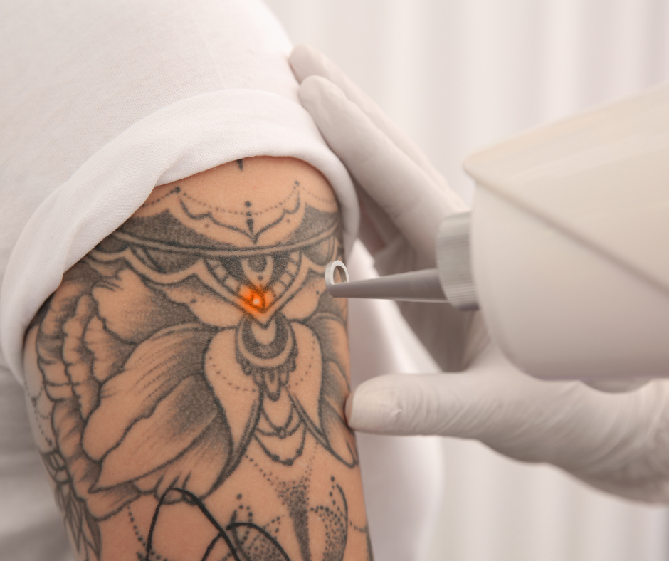 tattoo removal service